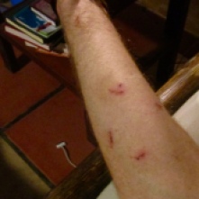 Mark's arm with squirrel monkey bites